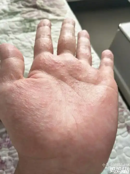 鹅掌风是会传染的手癣吗-125健康网