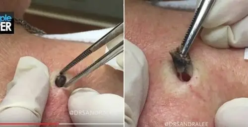 85岁老太太「巨无霸黑头」被医生拔出,背上出现大洞.