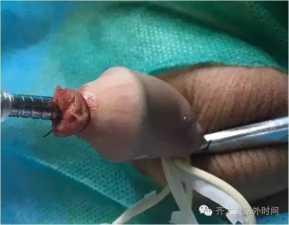 激发切割,手术完成,大家看是不是很整齐.