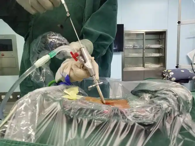 主任团队在经皮脊柱内镜下完成一例l5/s1高度游离脱垂椎间盘突出手术