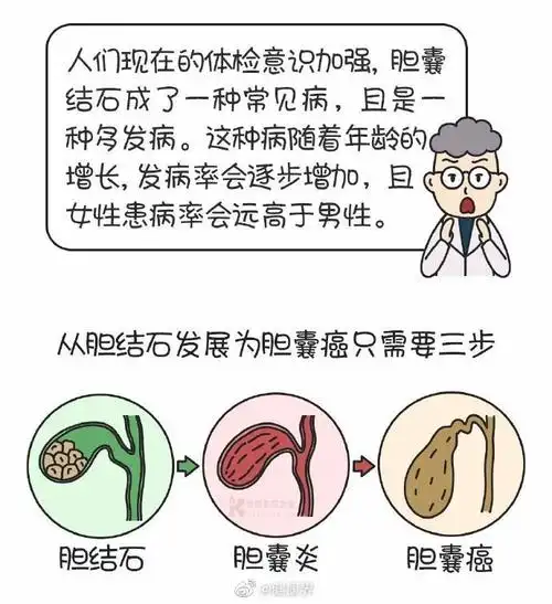 经常饿一顿或引发胆结石
