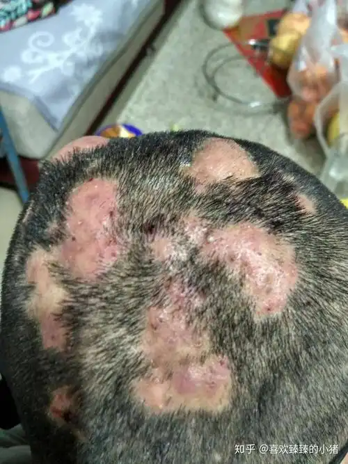 头部穿掘性毛囊炎