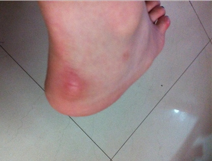 脚后跟起了个硬疙瘩,不碰不疼,穿鞋就很痛,摸着像骨头长出来一块,这是