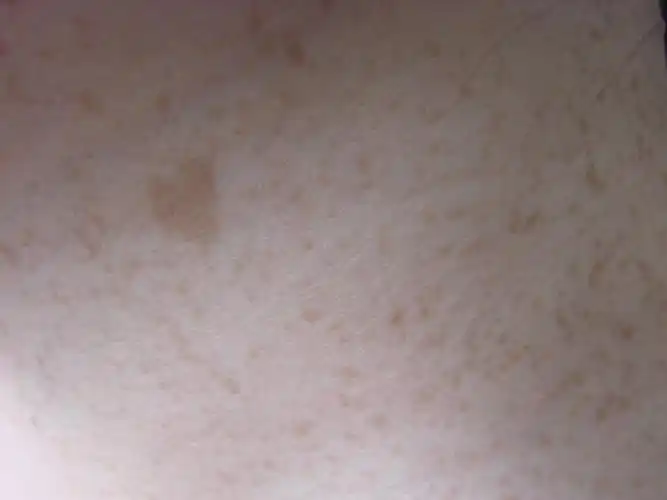 皮肤病色素沉着斑块求教