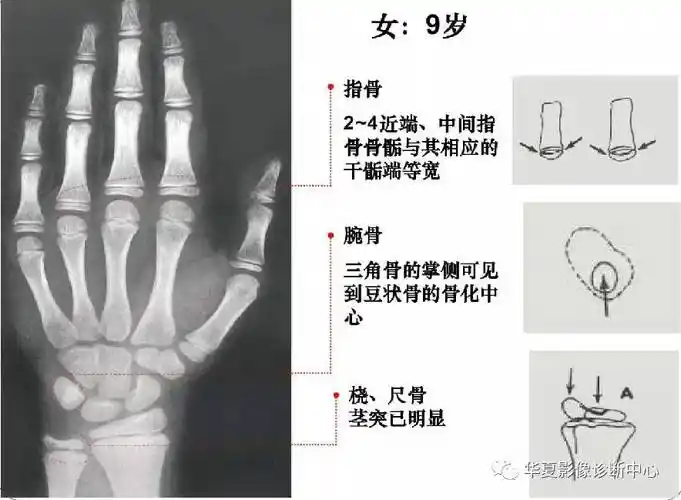 有了这张骨龄图轻松了解孩子的成长情况
