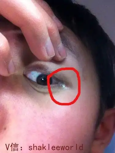 眼角有白色的分泌物,是什么原因