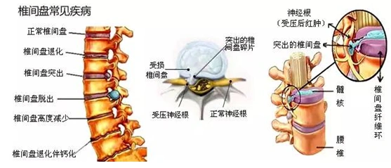 腰椎间盘突出症患者预防保健护理篇(二)