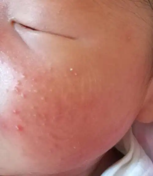 新生儿痤疮_痤疮_症状表现_治疗方式 - 好大夫在线