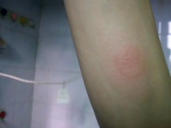 ppd试验双圈图 - 结核病防治讨论版 - 爱爱医医学论坛 - 爱爱医医学网