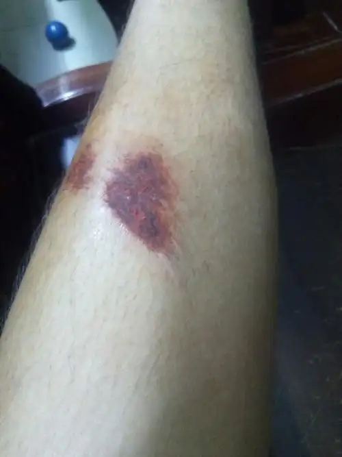 想当兵,脚上这样的皮外伤能过吗征兵体检吗?