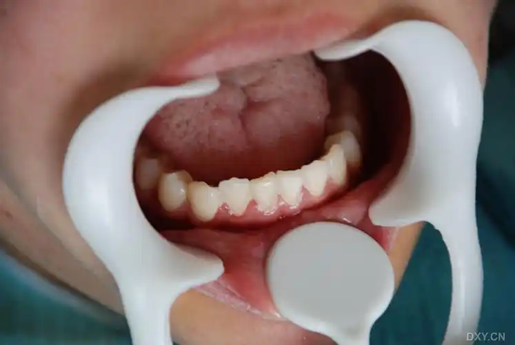 【讨论】颌骨囊肿 - 口腔 -丁香园论坛