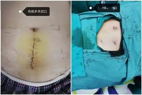 毫米间的艺术宫外孕微创手术