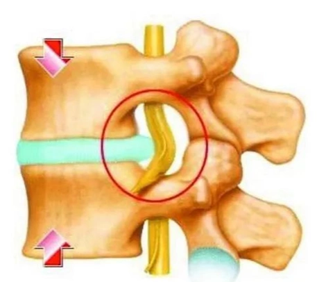 女人得腰椎间盘突出如何治疗(女人腰椎间盘突出是什么原因引起的)