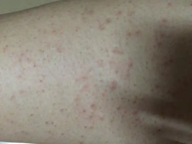 今天突然发现大腿正面有好多红色小疙瘩,是得的什么病?怎么治?