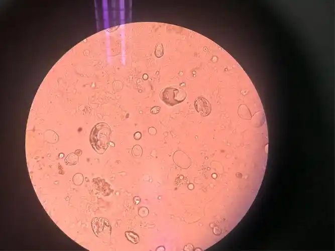 病例小分享 写美篇粪便淀粉颗粒介绍: 粪便淀粉颗粒,是粪便显微镜检查