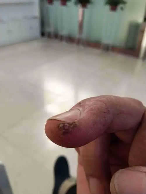 想问一下,手上的这个谁知道?长得什么?开裂,开花,有些人.谢谢!