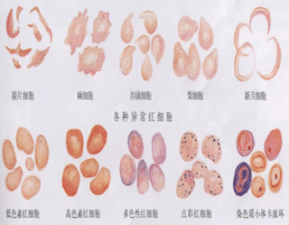 各种异常红细胞