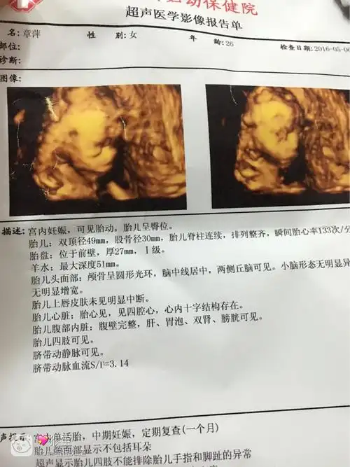 怀孕20周做的四维彩超