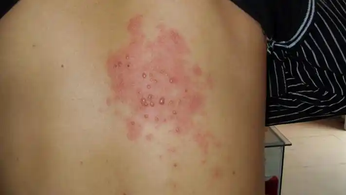 疱疹图片大全 (46)_有来医生