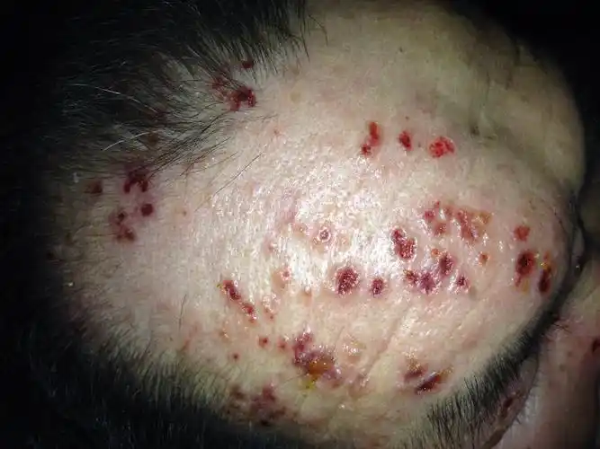 我爸放化疗之后头部出现局部起水泡溃烂请教如何处理