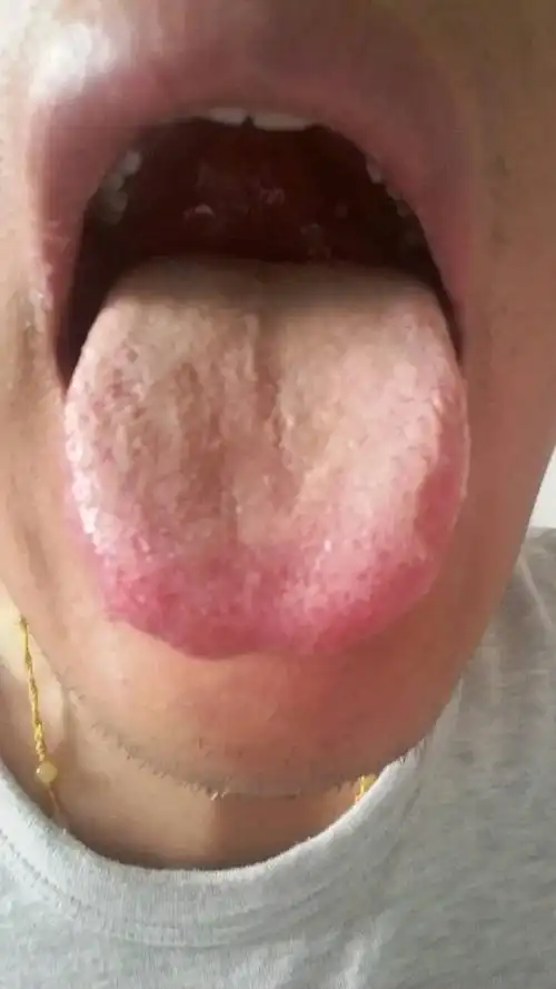 请问我的舌苔这一块呈现这个颜色是怎么回事?
