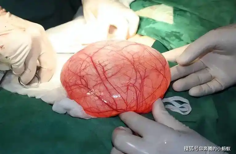 发现子宫囊肿饮食要注意该吃和不该吃的要谨记