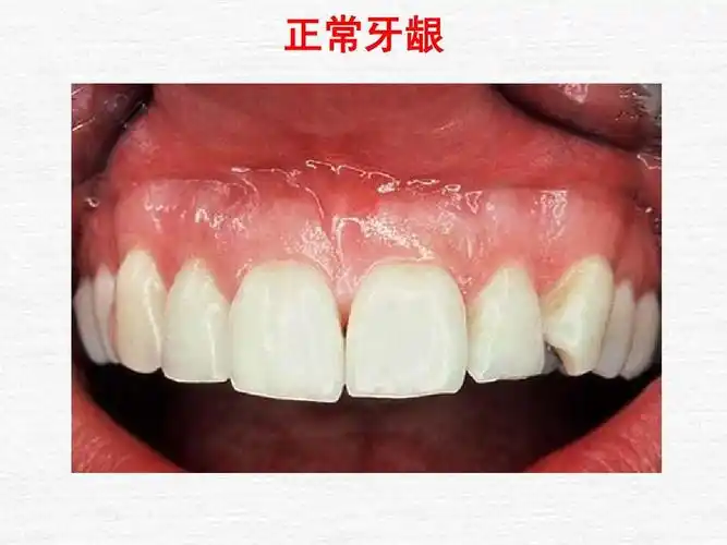 正常牙龈