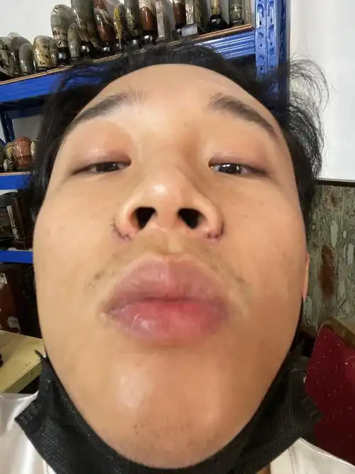 鼻孔不对称严重