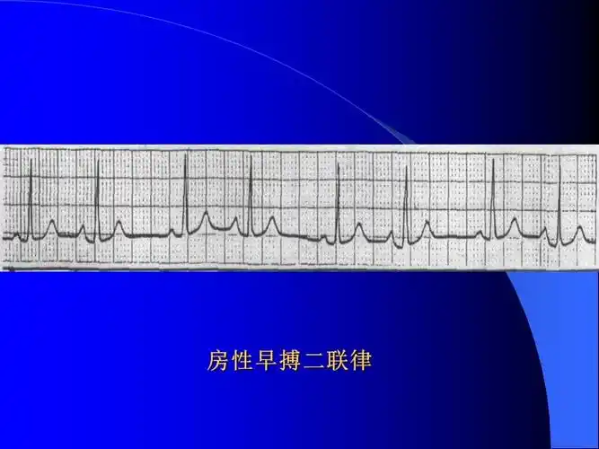 房性早搏二联律
