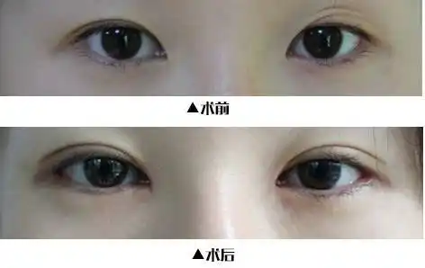 开外眼角和下睑下至,想变大眼的人必须知道的事