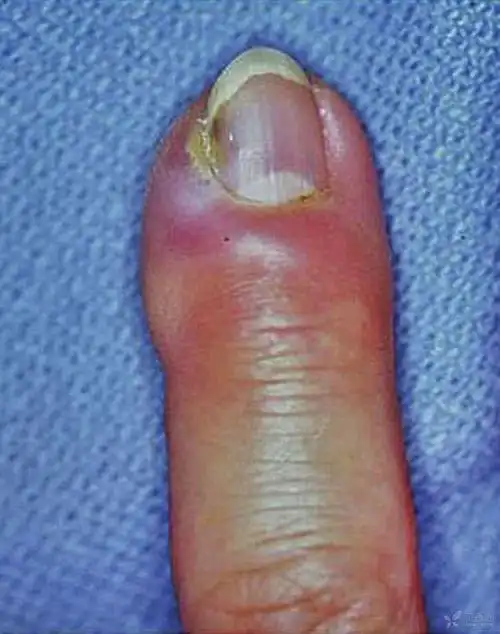 急性和慢性手指甲沟炎