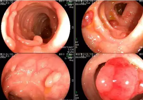 关于肠镜检查你想知道的都在这里