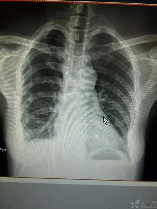 多发性肋骨骨折