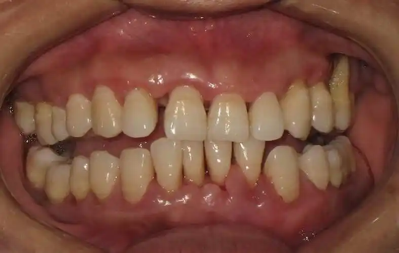 牙周炎图片_牙周炎症状表现图片大全_有来医生