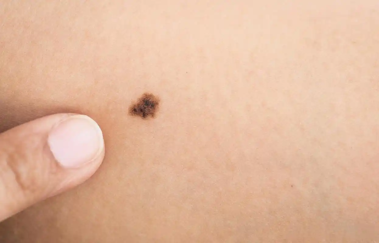 黑色素瘤# 近些年,黑色素瘤发病率逐年上升.