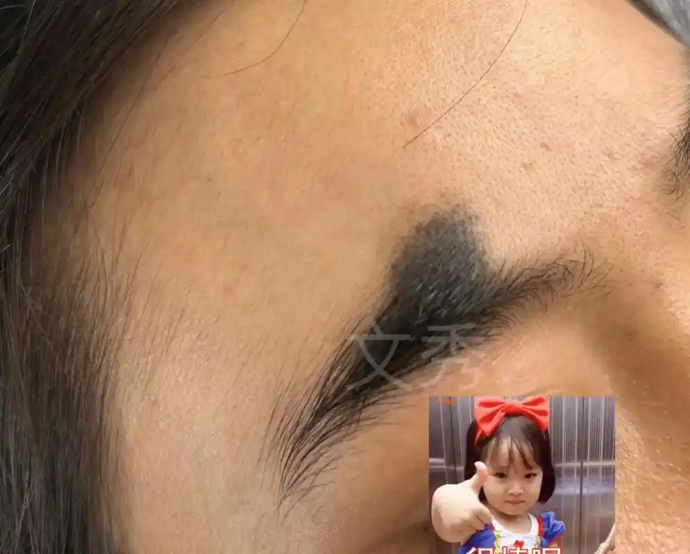 兽皮胎记,黑色胎记,痣,黑痣.如果你脸上有这样从娘胎带出来的 - 抖音