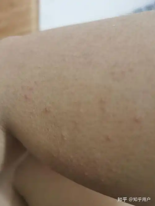 胳膊手臂反复起起小红疙瘩不疼不痒