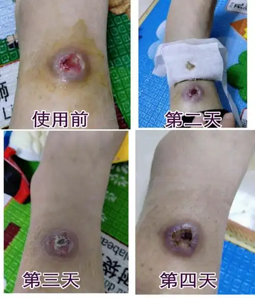 碘伏的作用与功效6大功效你知道几个