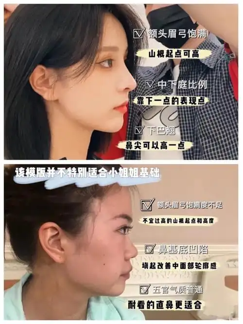 隆鼻分享之山根篇