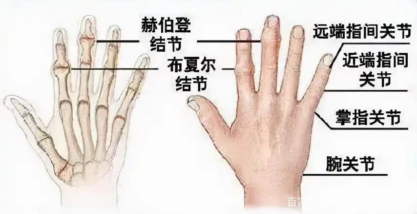 手指关节疼痛变形一定是类风湿吗?