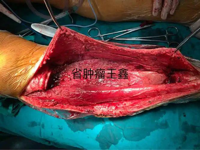 显微外科技术在骨肿瘤外科治疗中的应用