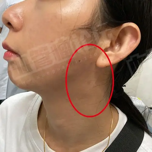 来自张颈部静脉畸形海绵状血管瘤患者日记