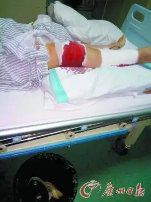 小徐被摔伤的腿.