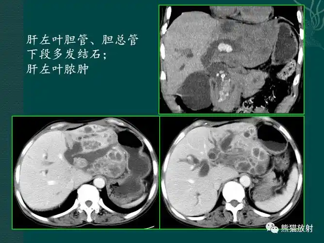 胆系病变丨ct及mri诊断