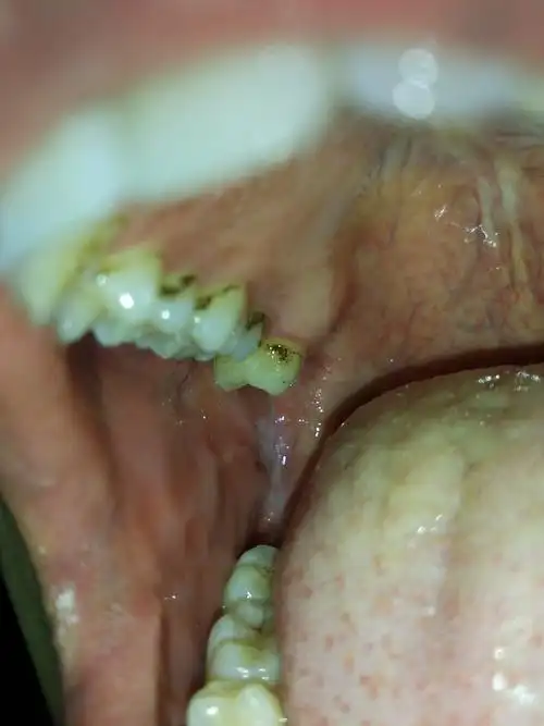 我想问一下我牙齿上的那些黑斑是什么