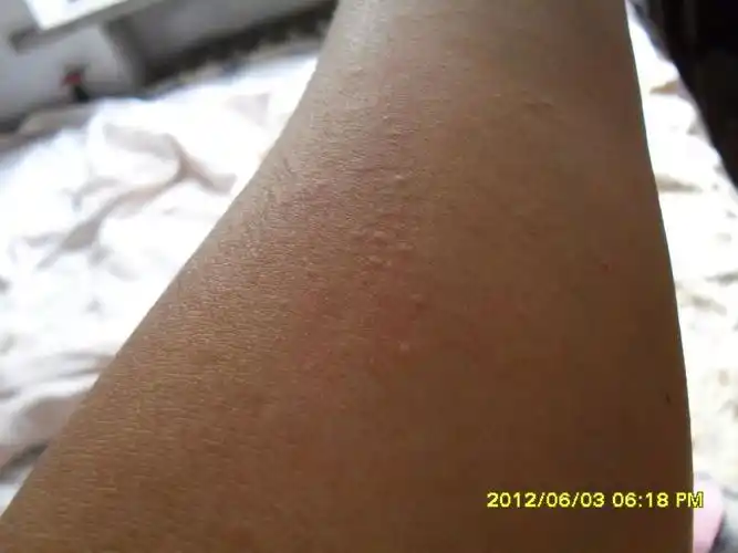 感觉四肢,背部剧烈瘙痒,起粟粒大小丘疹