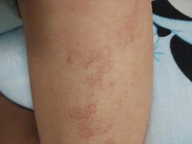 我是16岁男生,我胳膊上为什么会长这些红红的斑,很多年了,怎么去除?