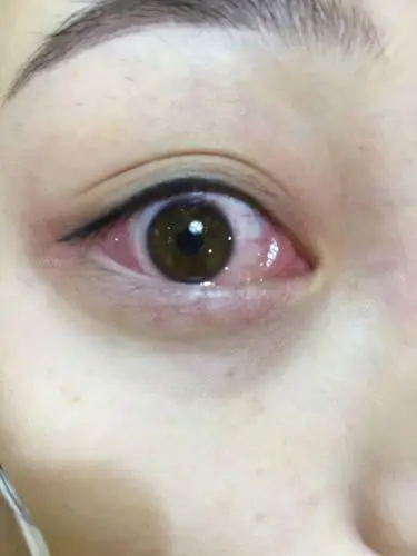 眼睛起来感觉很痒,有异物,照镜子竟然发现眼角两侧的肉都覆盖了很多