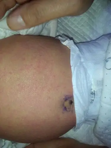 月子里的孩子肚皮上长的这种红疙瘩是什么全身都没有就肚子上有