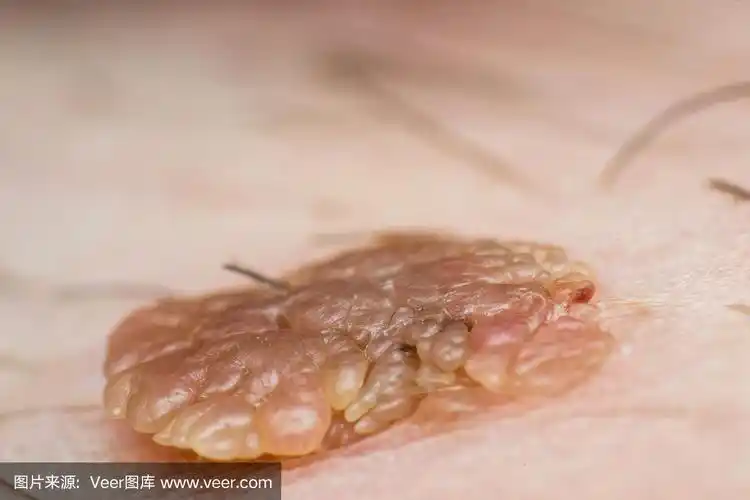 皮肤疣,乳头状瘤病毒感染的微距照片